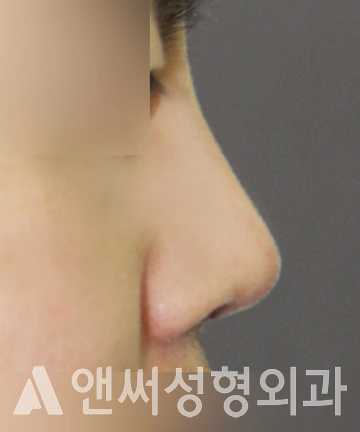 Answer Plastic Surgery case 346: After