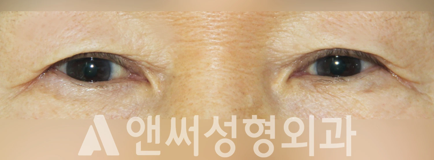 Answer Plastic Surgery case 345: Before