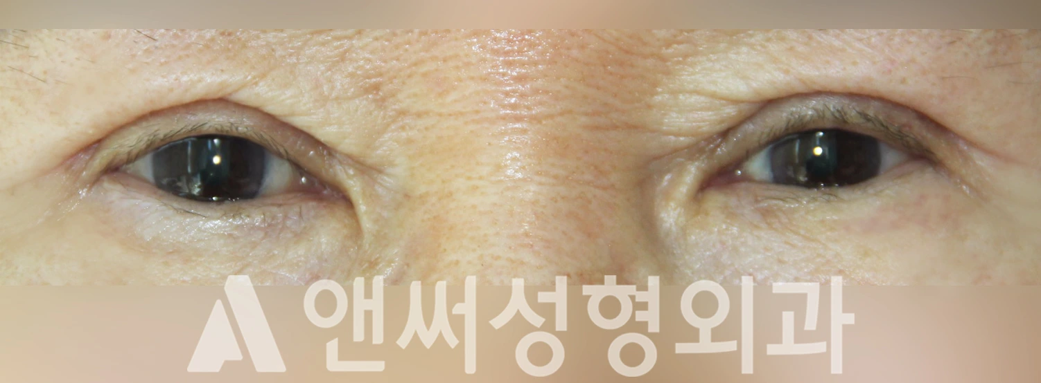 Answer Plastic Surgery case 345: After