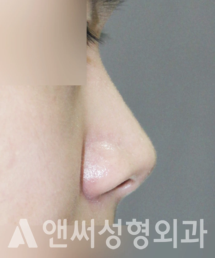 Answer Plastic Surgery case 344: Before