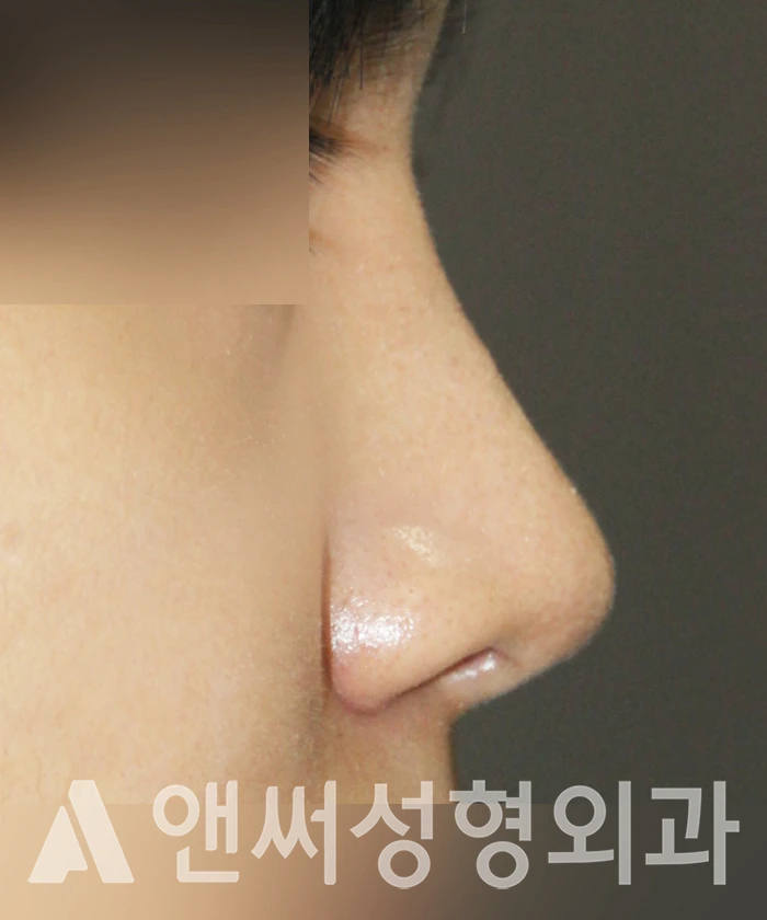 Answer Plastic Surgery case 344: After