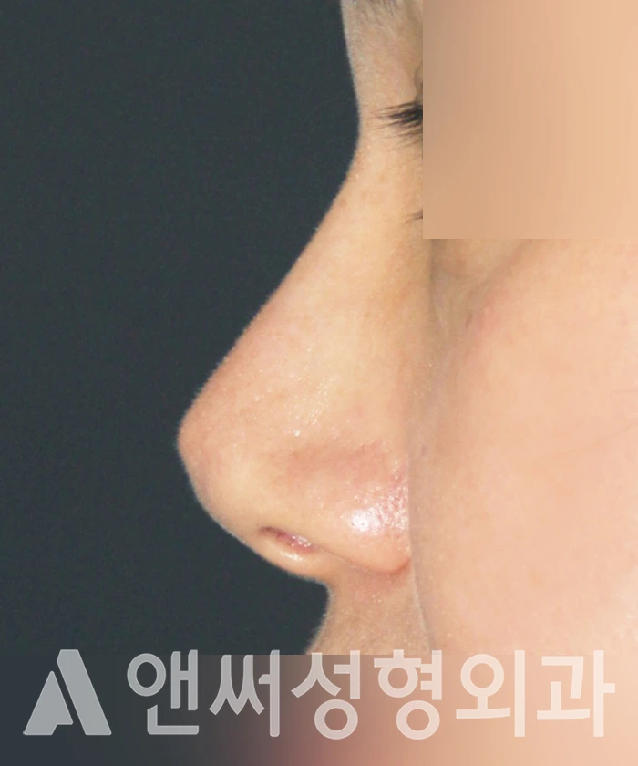 Answer Plastic Surgery case 343: Before
