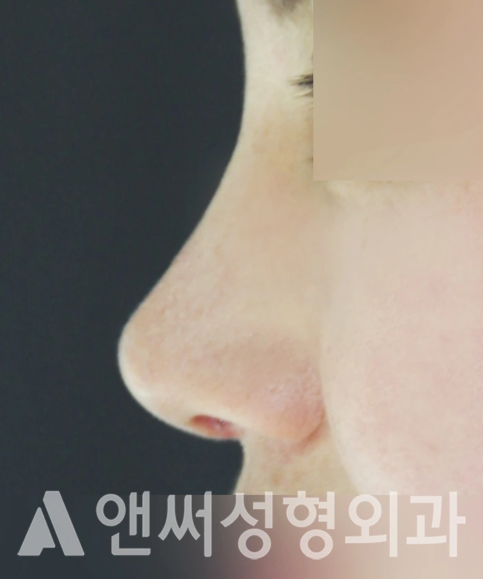 Answer Plastic Surgery case 343: After