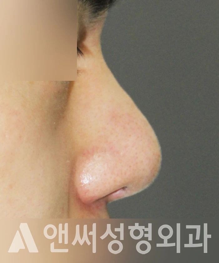 Answer Plastic Surgery case 342: Before