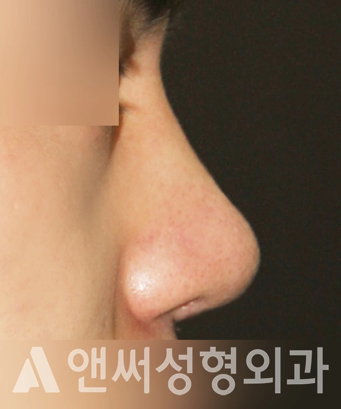 Answer Plastic Surgery case 342: After