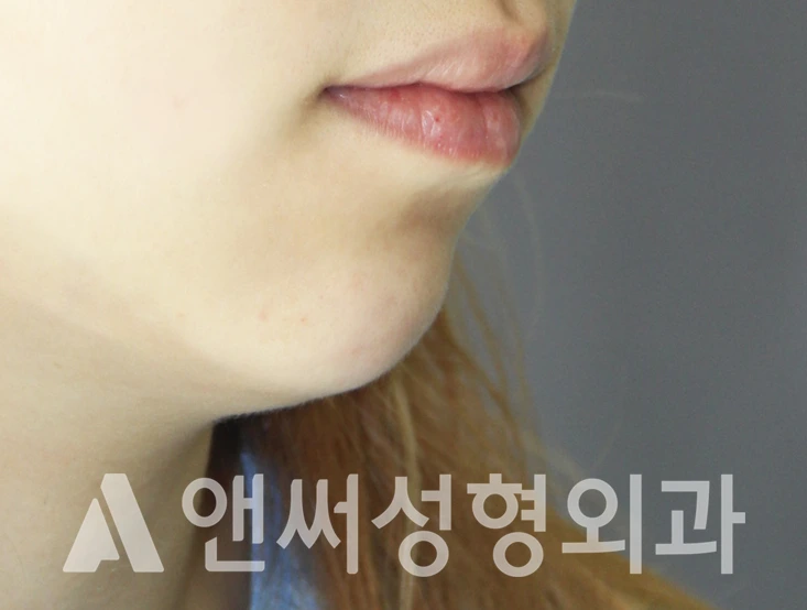 Answer Plastic Surgery case 341: Before