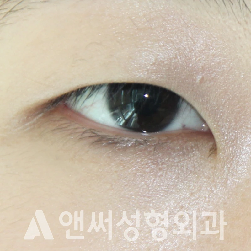 Answer Plastic Surgery case 339: Before