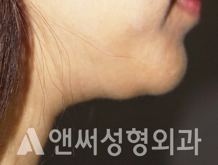 Answer Plastic Surgery case 338: Before