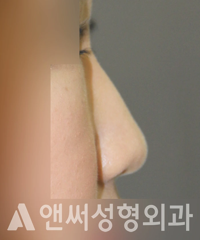 Answer Plastic Surgery case 337: Before