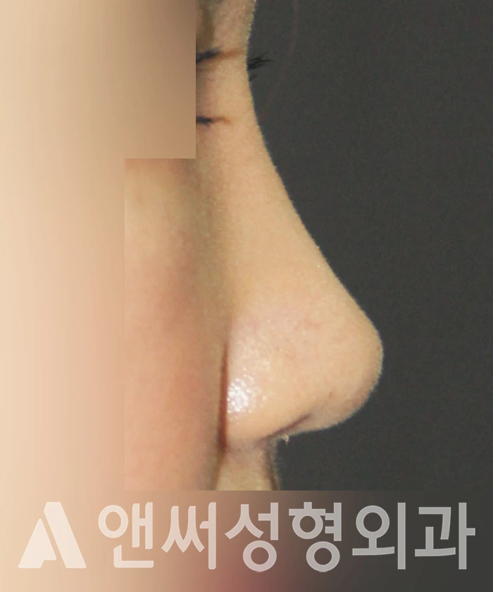Answer Plastic Surgery case 337: After