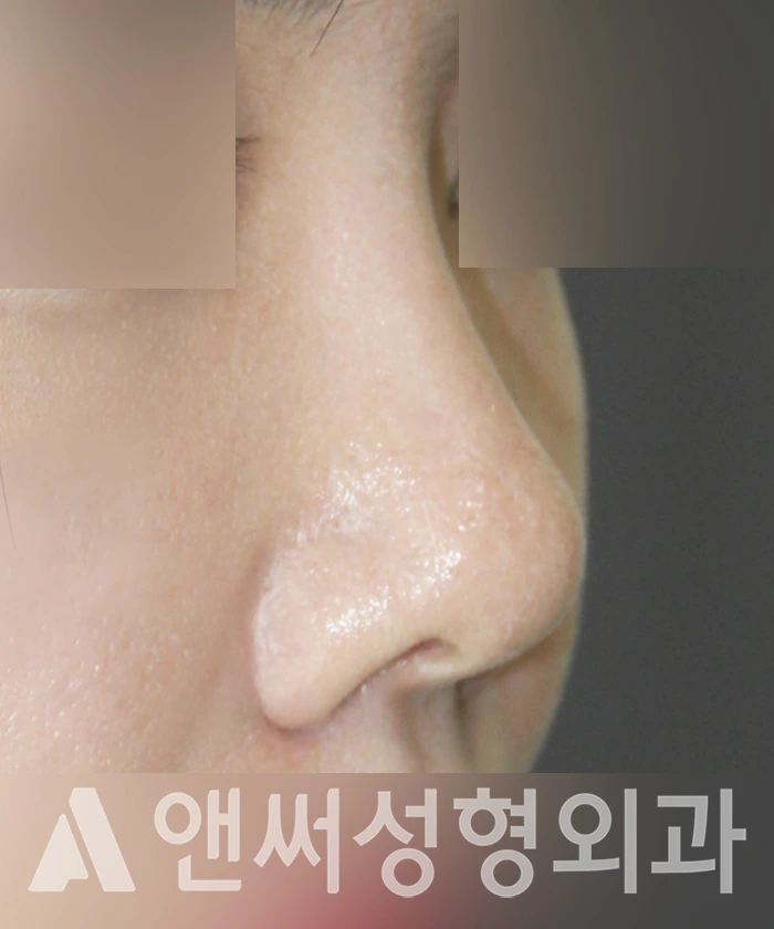 Answer Plastic Surgery case 336: Before