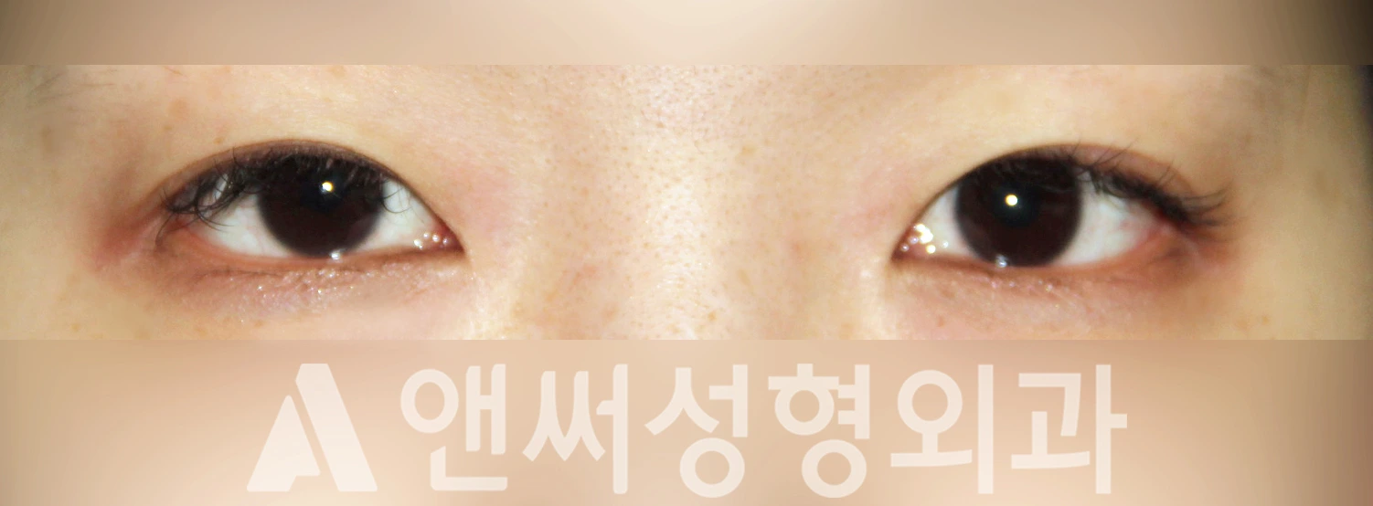 Answer Plastic Surgery case 335: Before