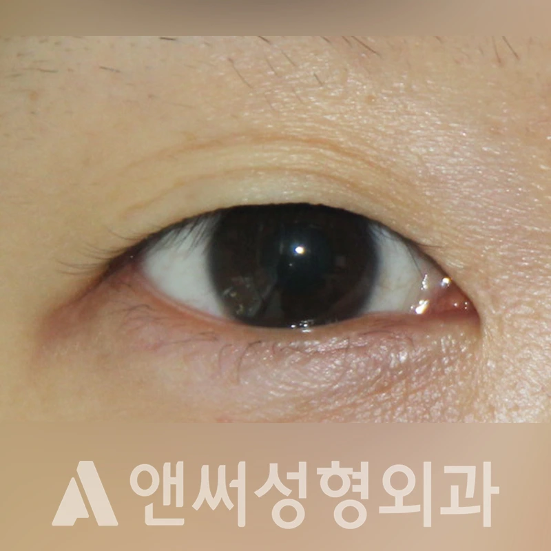 Answer Plastic Surgery case 334: Before