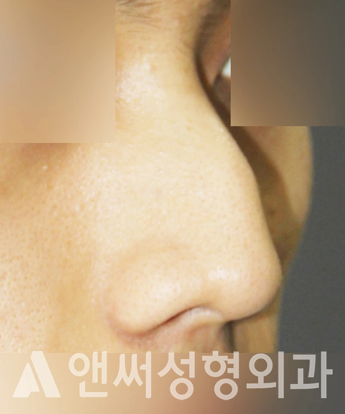 Answer Plastic Surgery case 333: Before