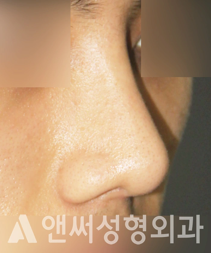 Answer Plastic Surgery case 333: After
