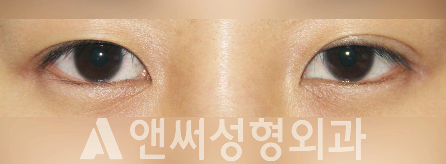Answer Plastic Surgery case 332: Before