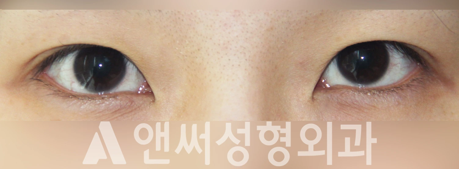 Answer Plastic Surgery case 331: Before