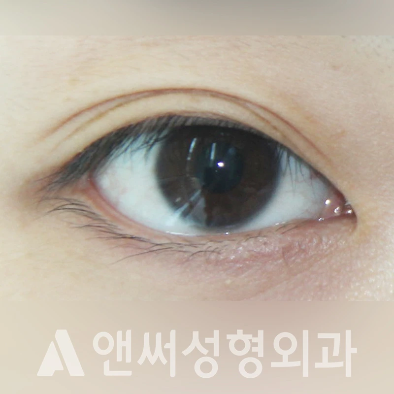 Answer Plastic Surgery case 330: Before