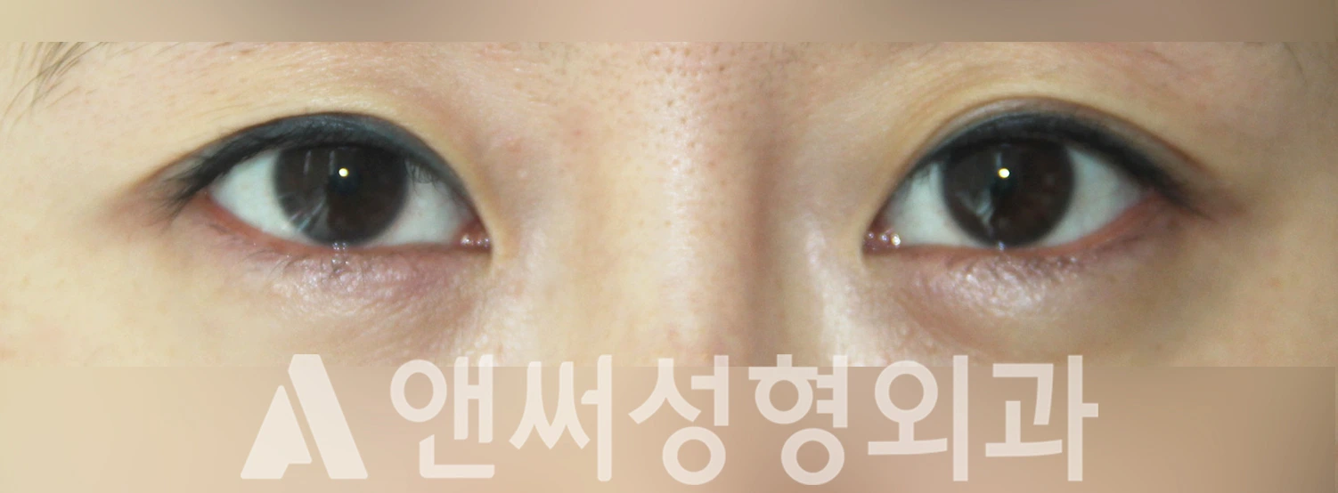 Answer Plastic Surgery case 329: Before