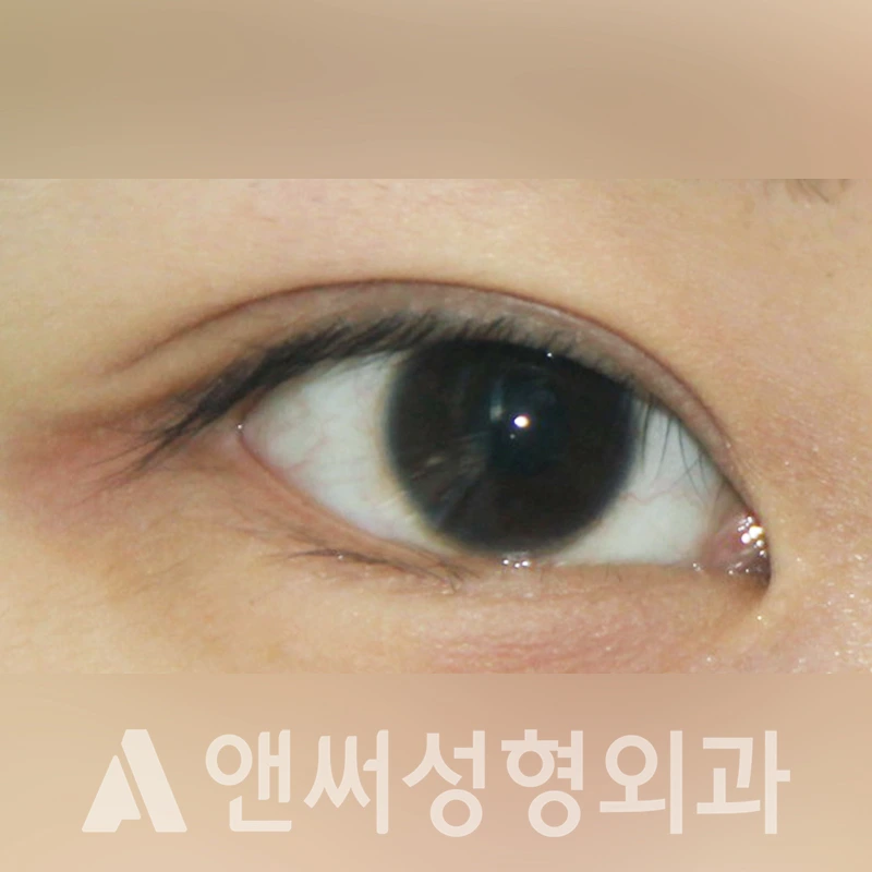 Answer Plastic Surgery case 328: Before