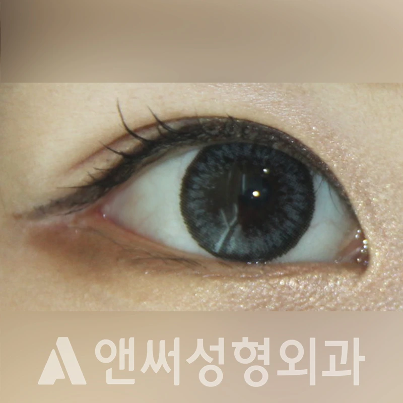 Answer Plastic Surgery case 328: After