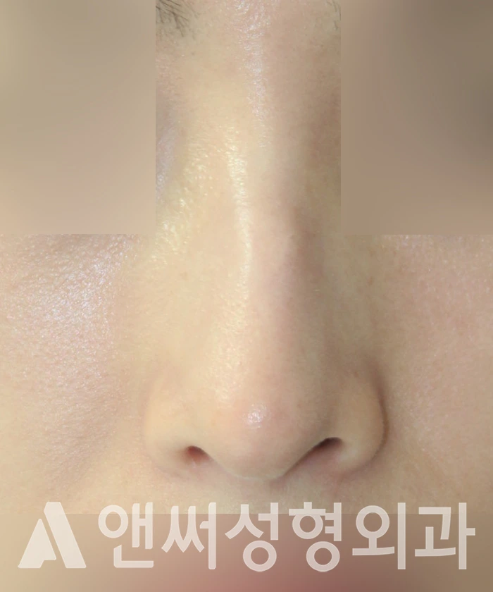 Answer Plastic Surgery case 327: Before