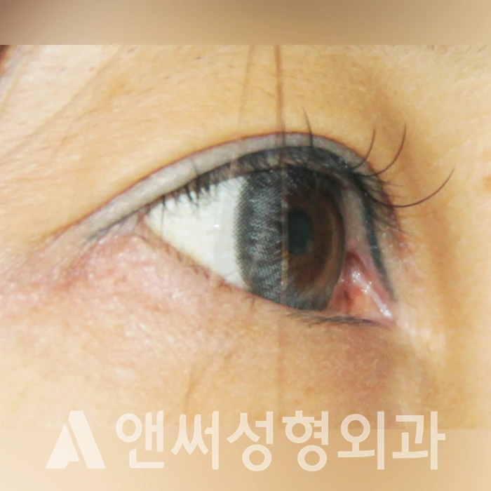 Answer Plastic Surgery case 326: Before