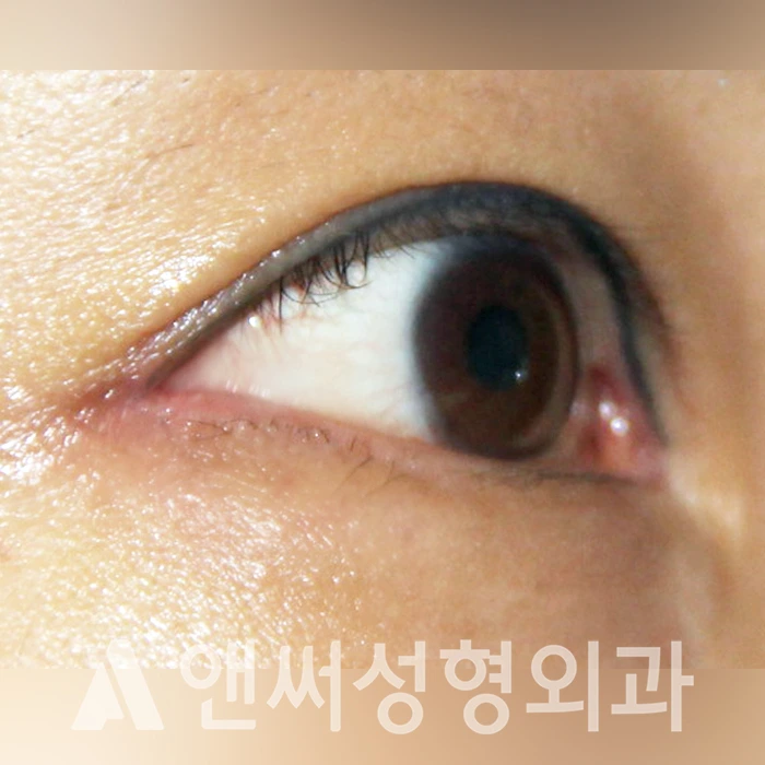 Answer Plastic Surgery case 326: After