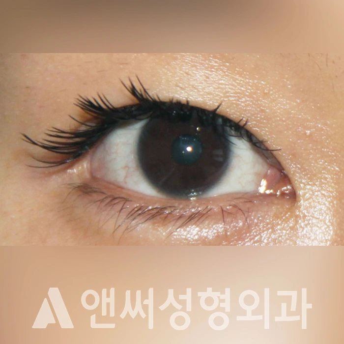 Answer Plastic Surgery case 325: Before
