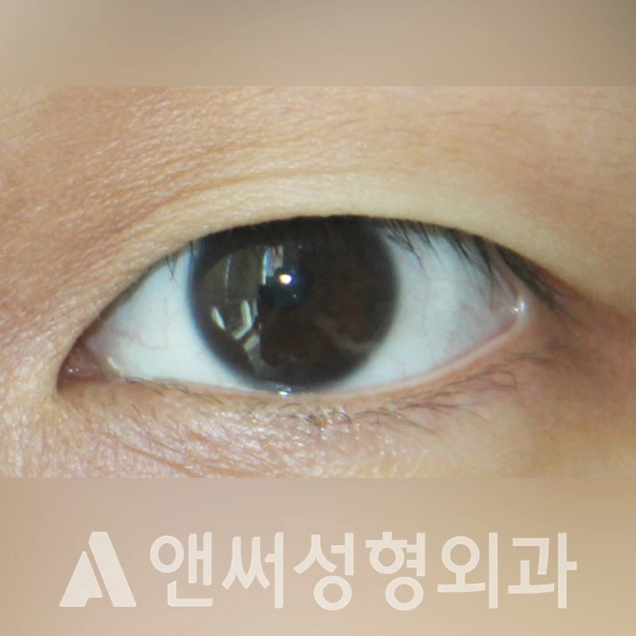 Answer Plastic Surgery case 324: Before