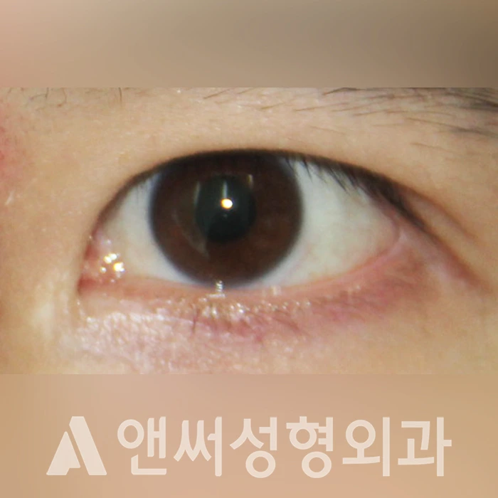 Answer Plastic Surgery case 323: Before