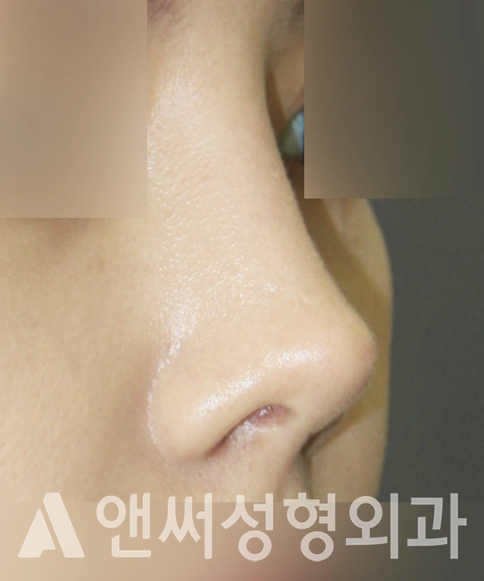 Answer Plastic Surgery case 322: Before
