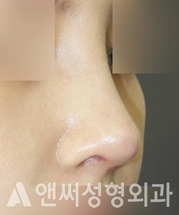 Answer Plastic Surgery case 322: After