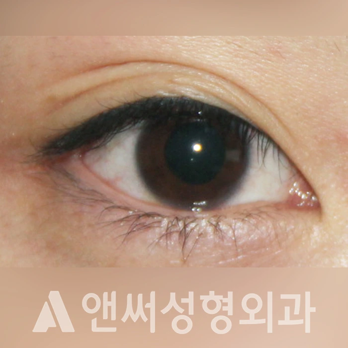 Answer Plastic Surgery case 321: Before