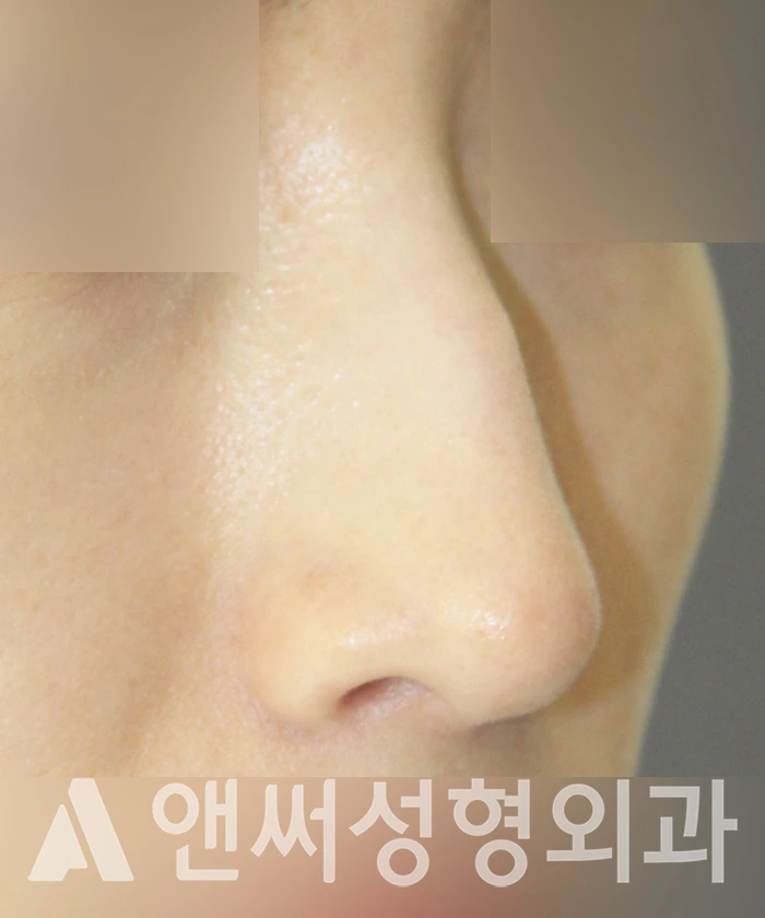 Answer Plastic Surgery case 320: Before