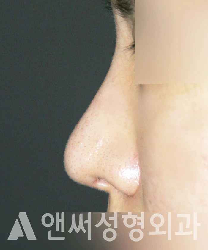 Answer Plastic Surgery case 318: Before