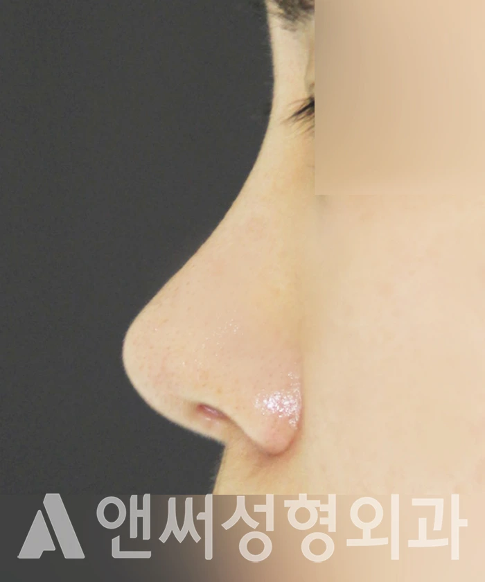 Answer Plastic Surgery case 318: After