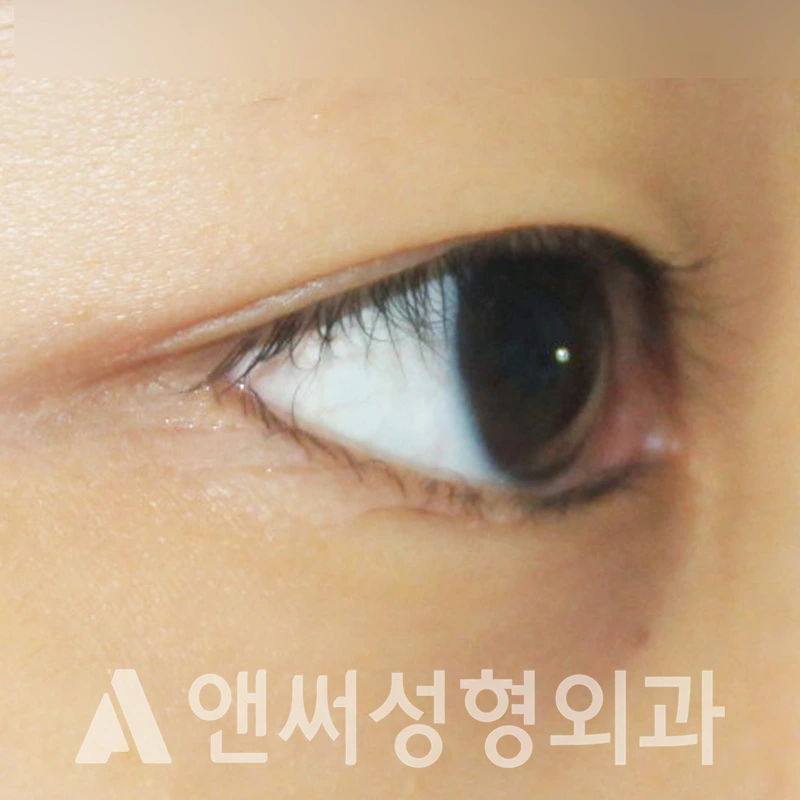 Answer Plastic Surgery case 317: Before