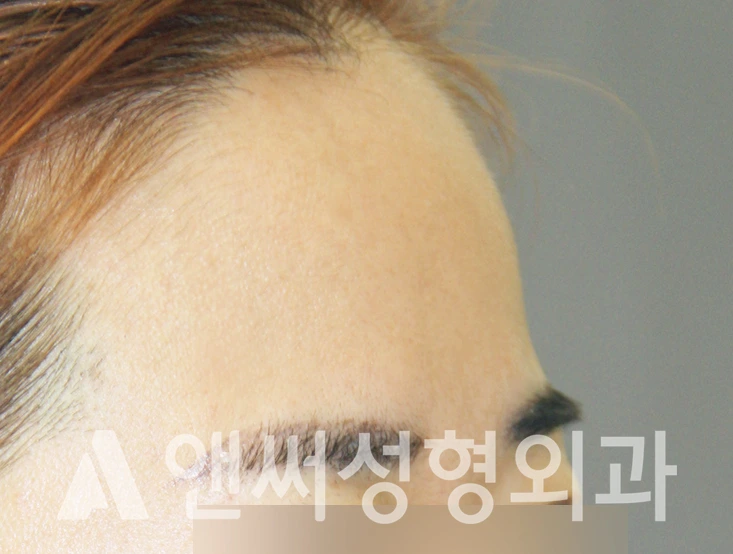 Answer Plastic Surgery case 316: Before