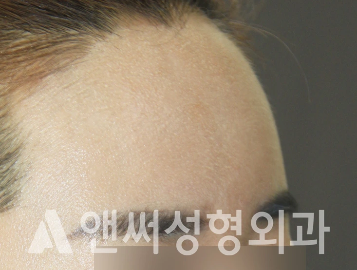 Answer Plastic Surgery case 316: After