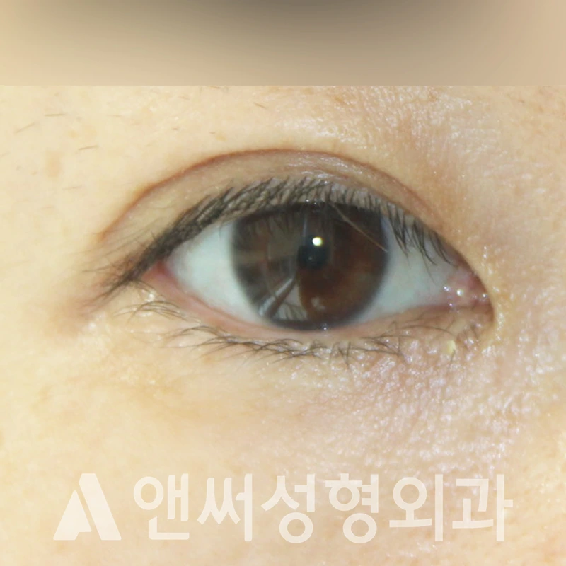 Answer Plastic Surgery case 315: Before