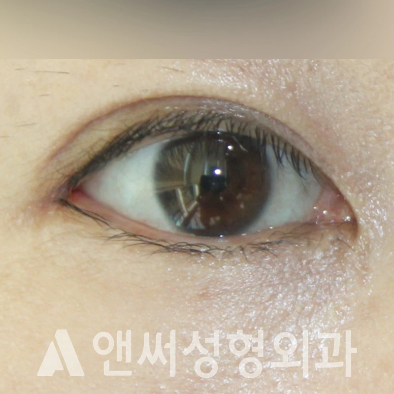 Answer Plastic Surgery case 315: After
