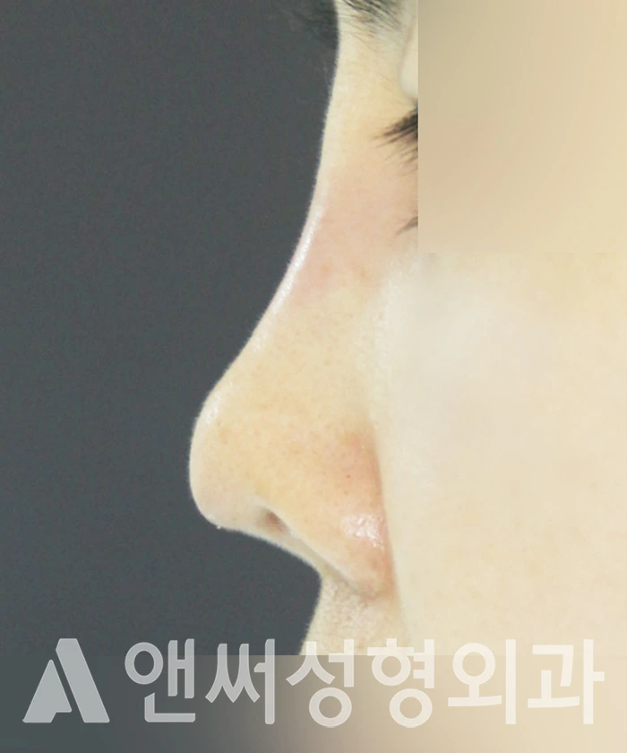 Answer Plastic Surgery case 314: Before