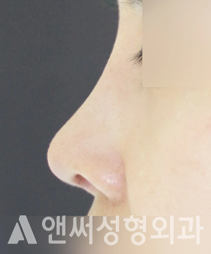 Answer Plastic Surgery case 314: After