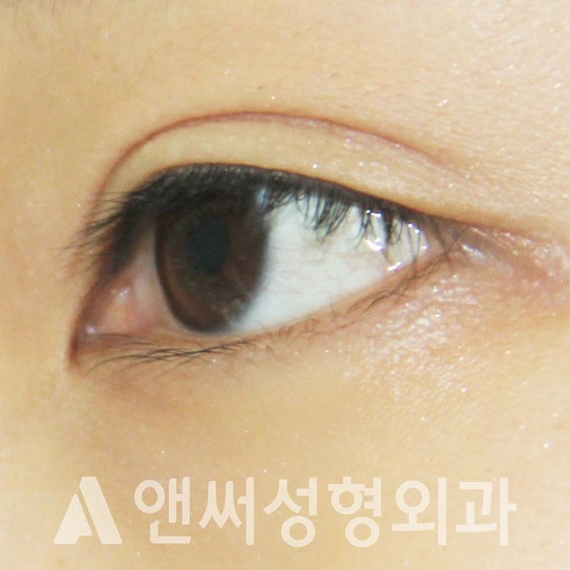Answer Plastic Surgery case 313: Before