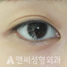 Answer Plastic Surgery case 283: Before