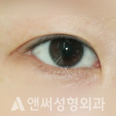 Answer Plastic Surgery case 281: Before