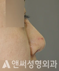 Answer Plastic Surgery case 278: Before