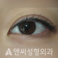 Answer Plastic Surgery case 265: Before