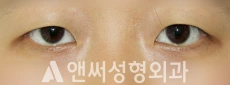Answer Plastic Surgery case 258: Before
